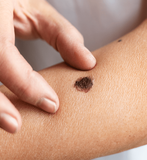 campanha melanoma - detecção e diagnóstico